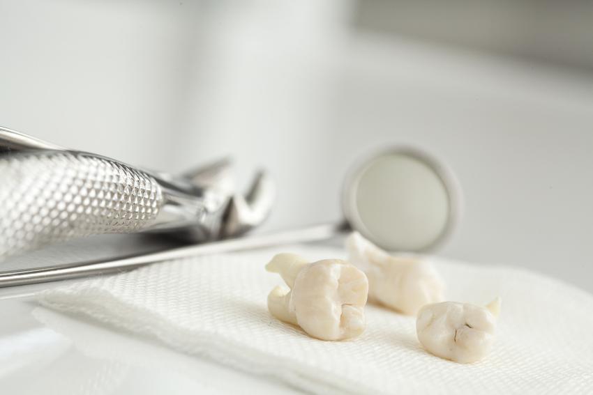 DentalX Downsview Dental Clinic/ Trusted Dentist wisdom tooth extraction information