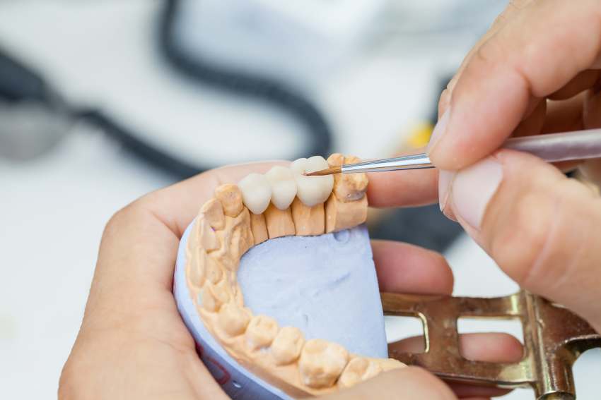DentalX Downsview Dental Clinic/ Trusted Dentist dental bridges