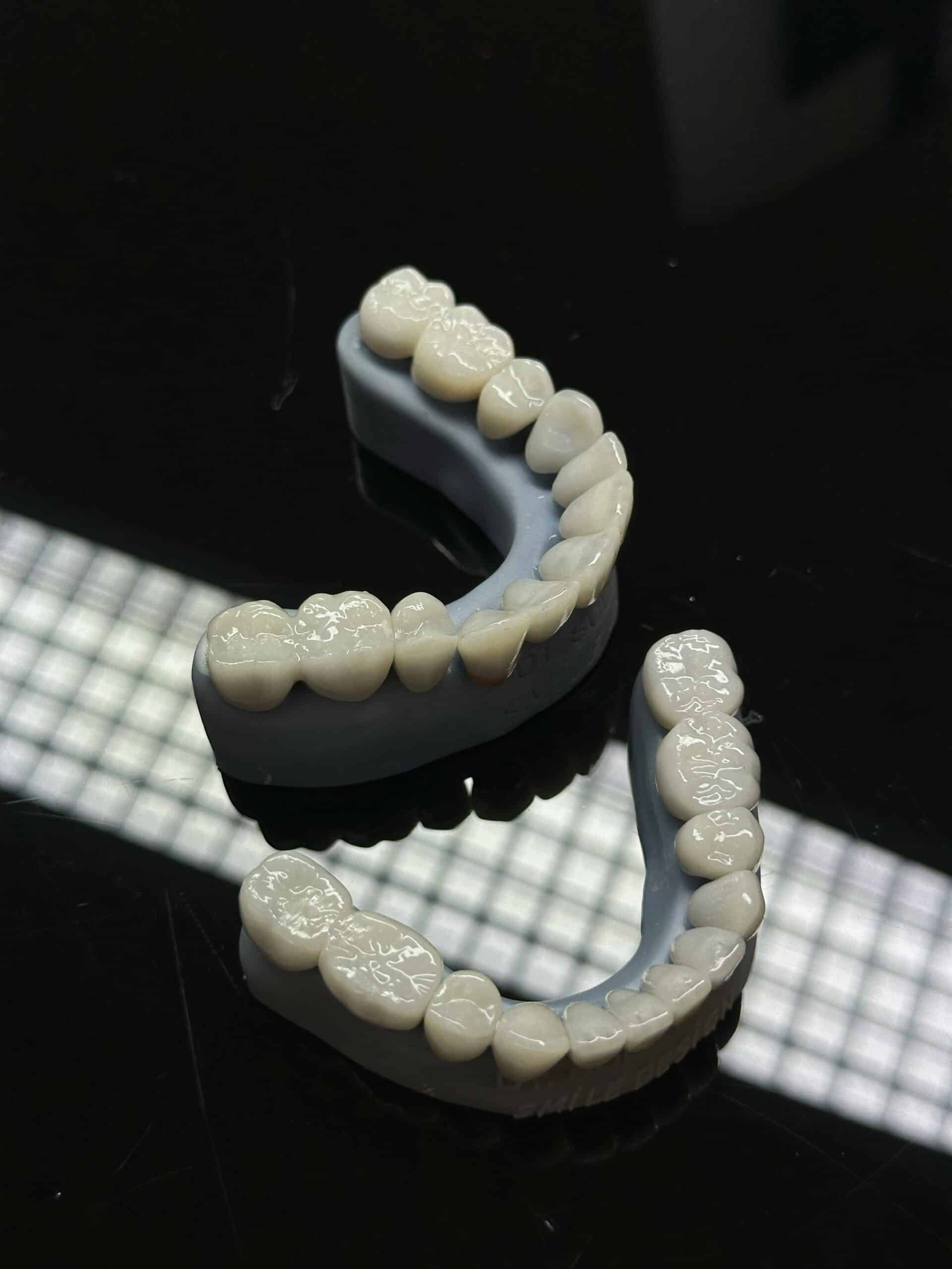 Dental Crowns and Bridges / DentalX Downsview Dental Clinic
